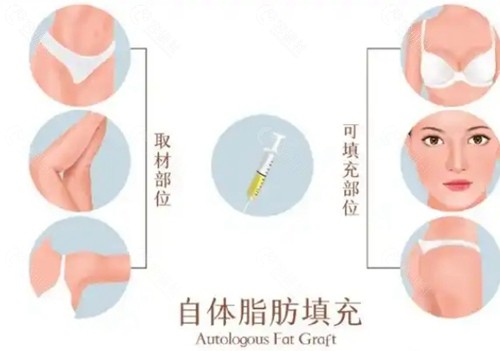 填充自体脂肪价格表