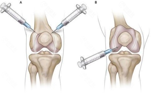 韩国圣路佳医院注射干细胞的优势