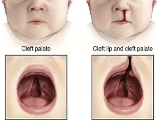 沈阳唇腭裂修复价格