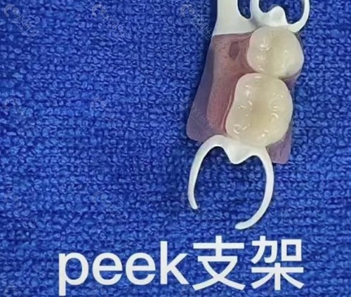 peek口腔支架优缺点有哪些？