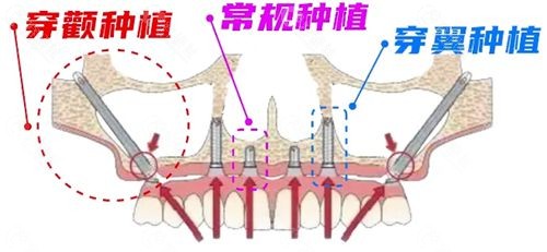 常规种植牙和穿颧穿翼板种植牙的区别