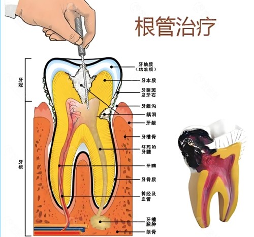 根管治疗价格表