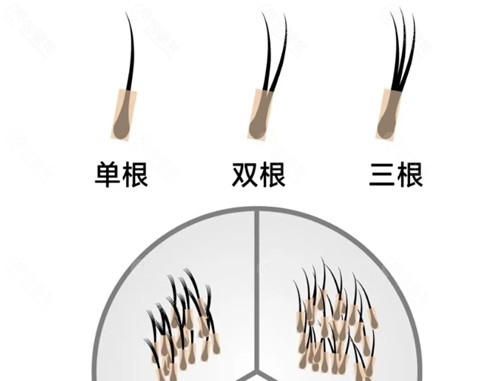 扬州植发价格表