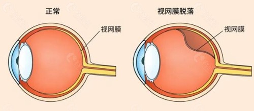 视网膜脱落和正常情况区别