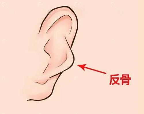 反骨耳矫正手术怎么做？