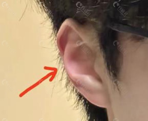 反骨耳矫正手术多少钱？
