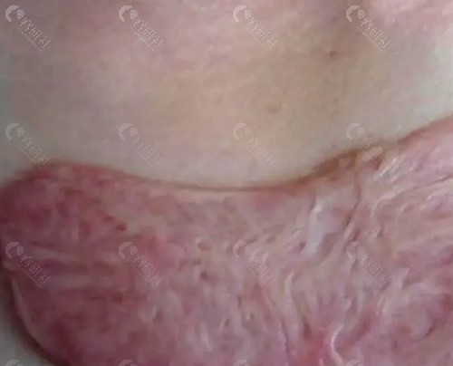 疤痕修复方法有哪些