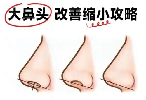 鼻翼缩小术的价格2025