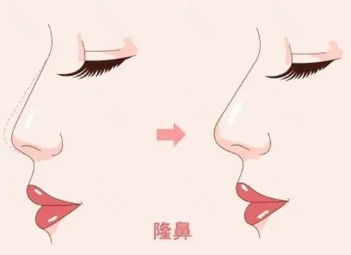 深圳隆鼻手术价格