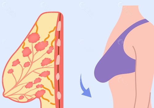 下垂型胸部图片