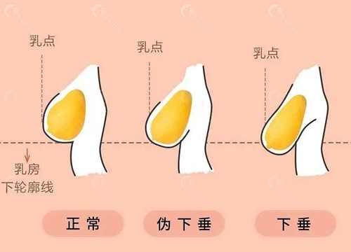 下垂型胸部提升方法