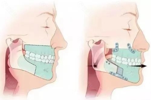 颏成型手术怎么操作？