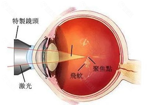 飞蚊症消融术怎么操作？