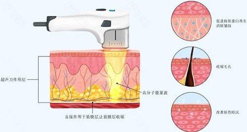 为什么医生不建议做超声炮？