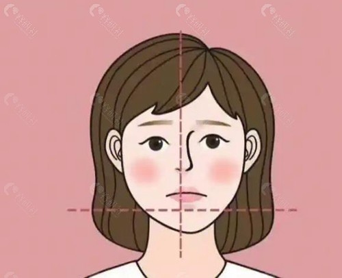 脸部不对称做正颌骨手术后悔了