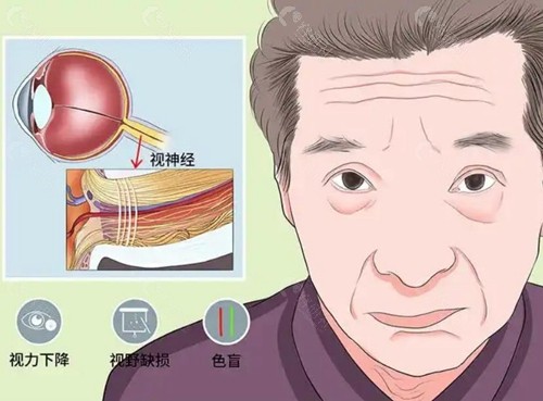 视神经萎缩有办法治疗吗？
