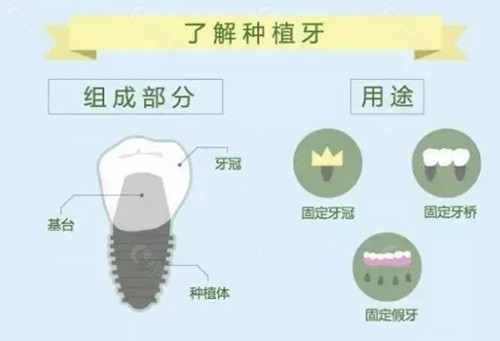衢州种植牙价格