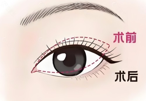 岳阳做双眼皮好的医生