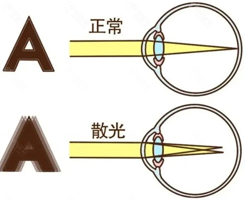 散光矫正手术价格