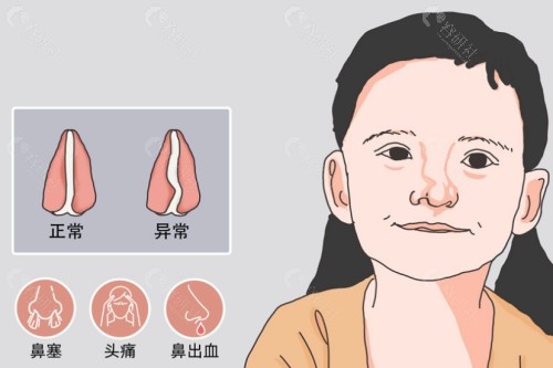 鼻中隔偏曲导致鼻塞不通气怎么办？