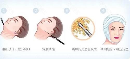 做双下巴抽脂后可以不戴头套吗？