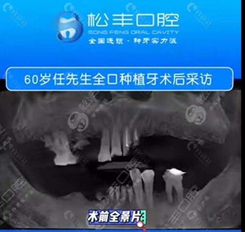 海口松丰口腔种植牙好吗
