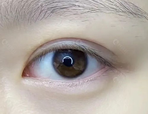 江门割双眼皮价格
