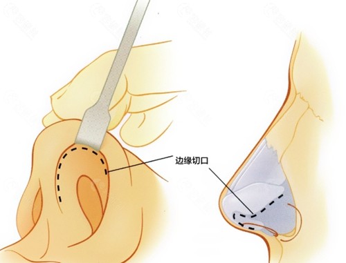 西安隆鼻手术价格
