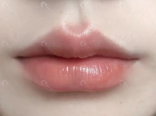 嘟嘟唇打什么玻尿酸好？