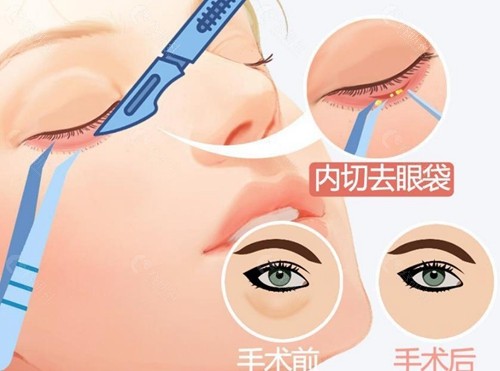 切完眼袋一周后又肿又硬是否正常？