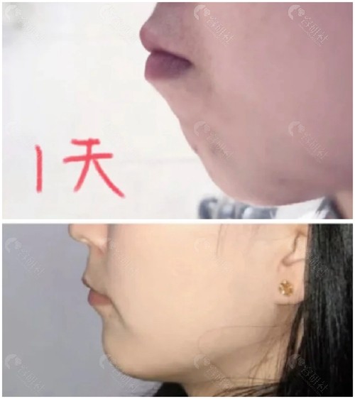 天包地矫正后脸型变化图