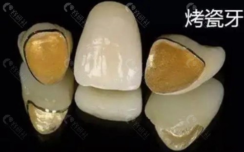 烤瓷牙修复费用可以报销吗？