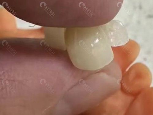 马里兰桥牙齿修复价格