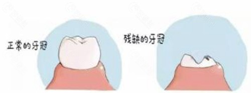 牙齿断了牙根还在哪种情况需要拔掉？