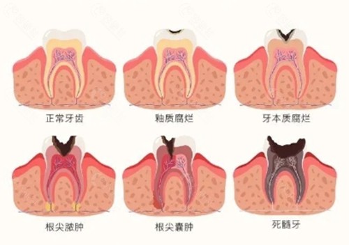根管治疗价格