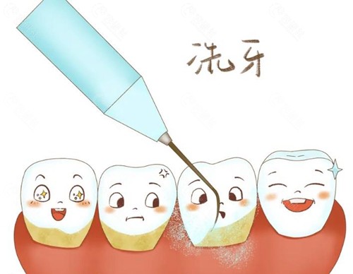 2025成都牙科洗牙多少钱？