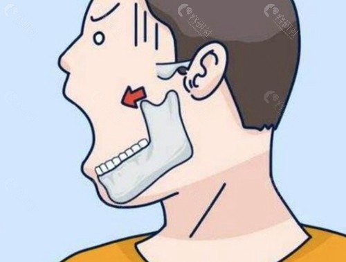 根尖截骨向内推多了怎么办？