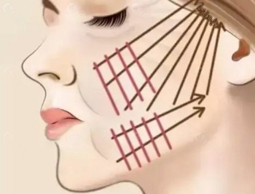3d织网面部提升可以维持多久？