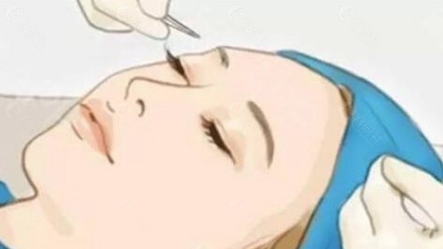 开外眼角