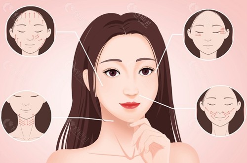 双平面提升术特别适合以下人群