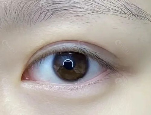 重庆割双眼皮手术价格 重庆割双眼皮手术价格