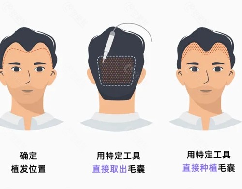 河源植发手术价格