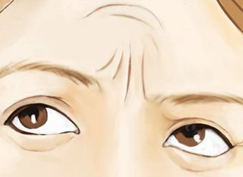内视镜皱眉肌切除是什么原理？