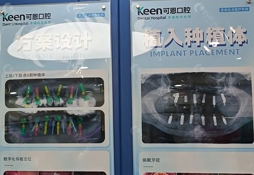 潍坊可恩口腔种植牙好吗