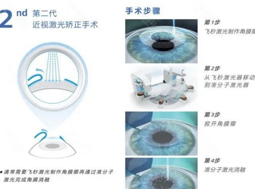 合肥近视手术医生