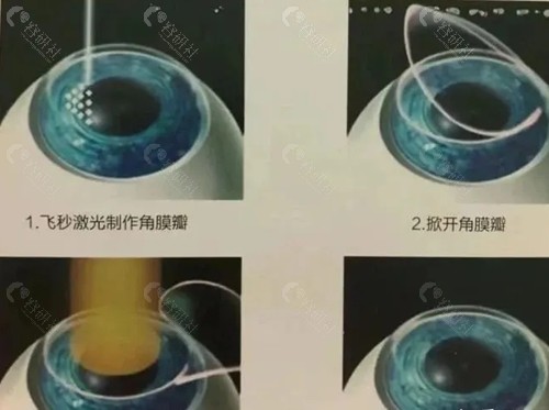 包头近视手术价格表