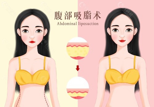 2025厦门吸脂手术价格一览