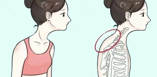 富贵包微创手术是局麻还是全麻？