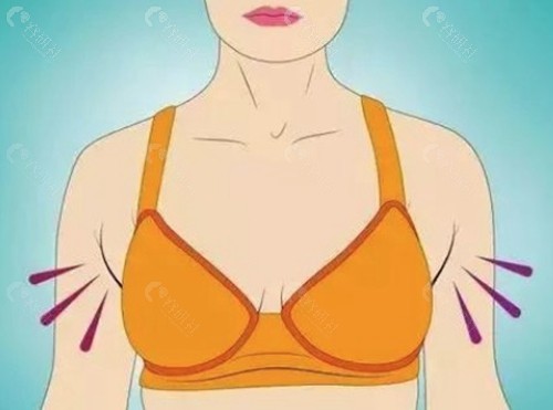 副乳吸脂价格一般多少钱？