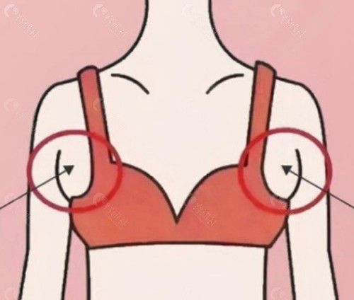 做副乳吸脂后一周还是突出一坨是失败了吗？